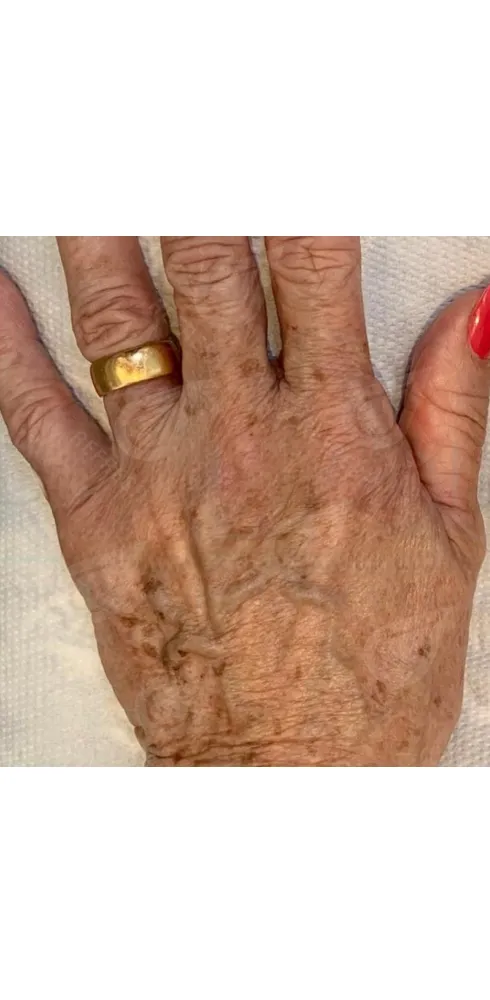 регенерация кожи 5