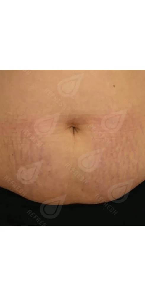 Реген.кожи7