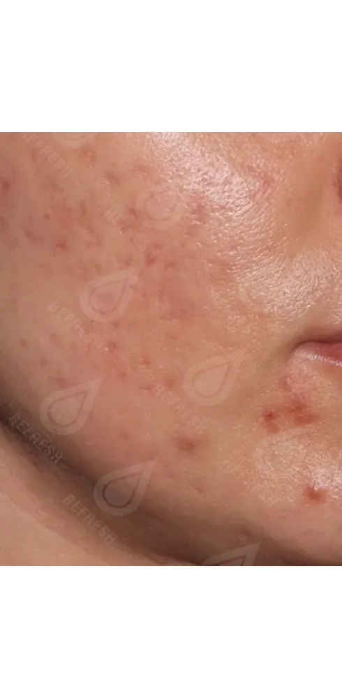 Реген.кожи3