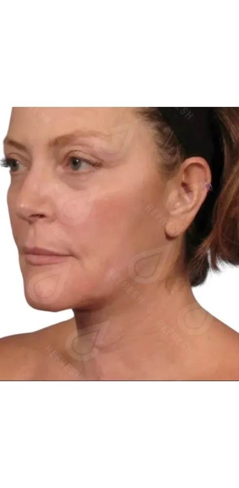 регенерация кожи 2