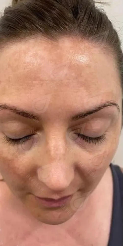 Биоревитализация