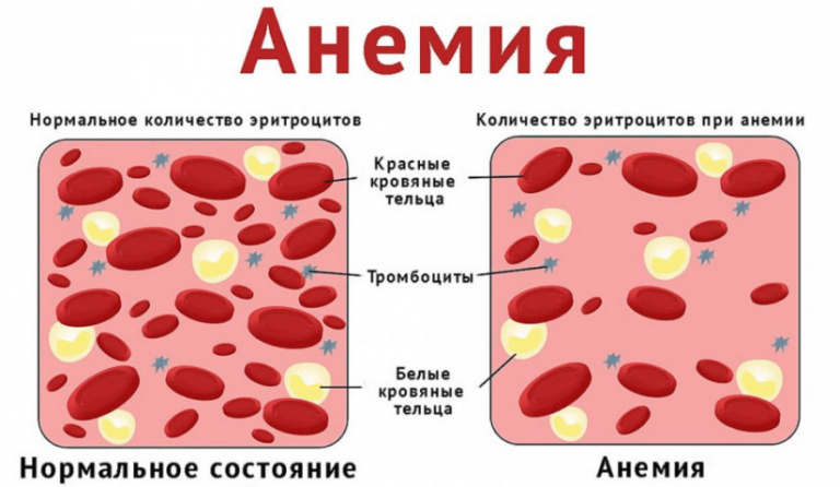 Какие анализы сдать при анемии
