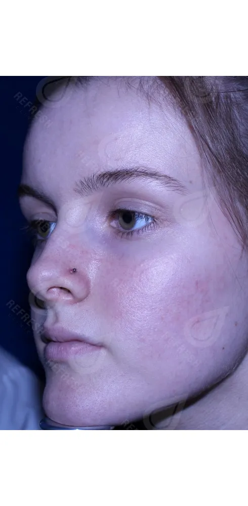 Реген.кожи1