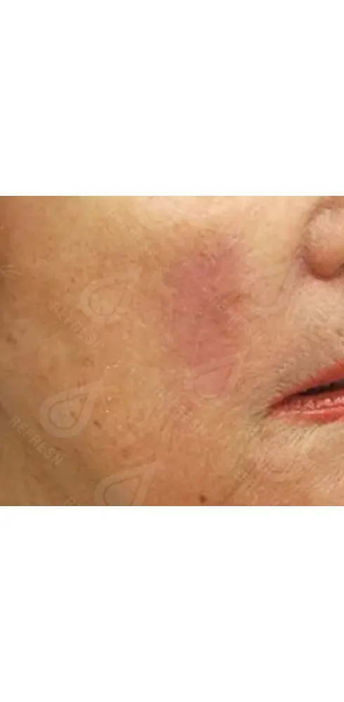 Реген.кожи4