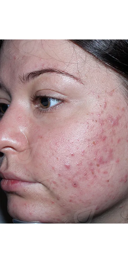 Реген.кожи2