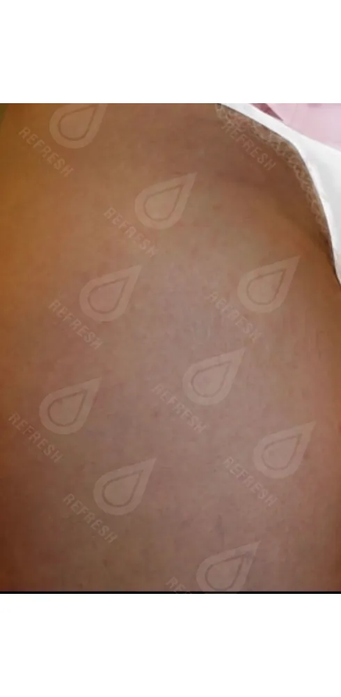 Реген.кожи8