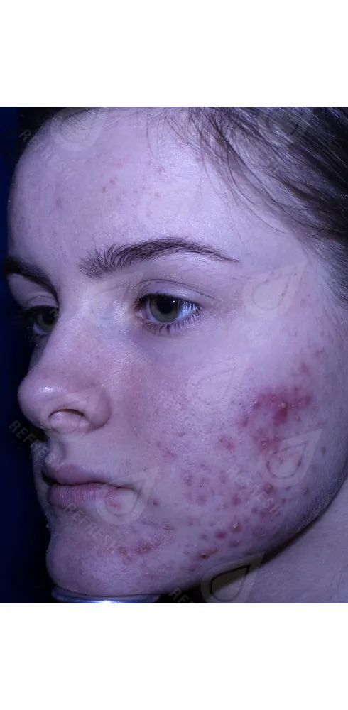 Реген.кожи1