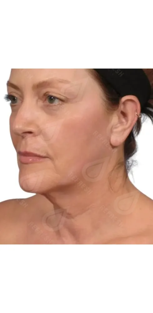 регенерация кожи 2