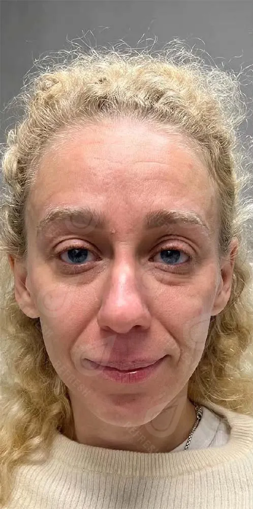  Биоревитализация 2