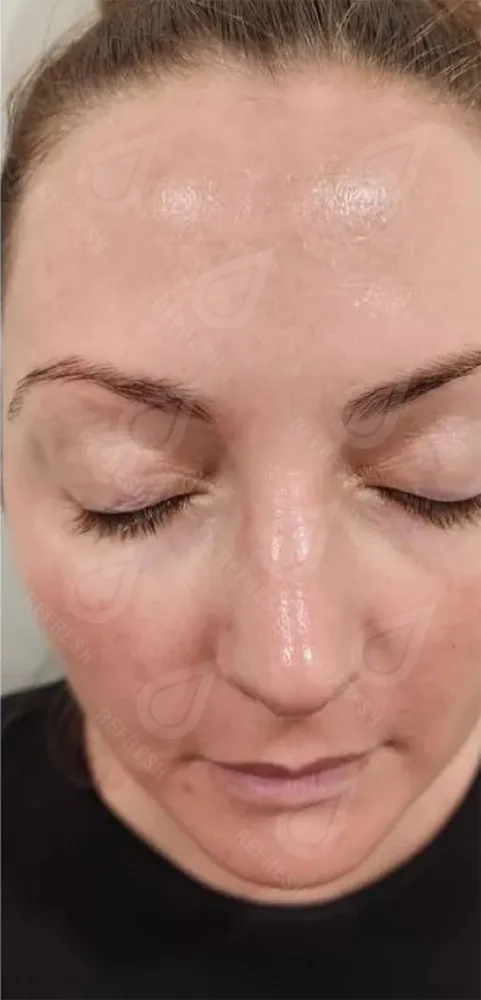 Биоревитализация