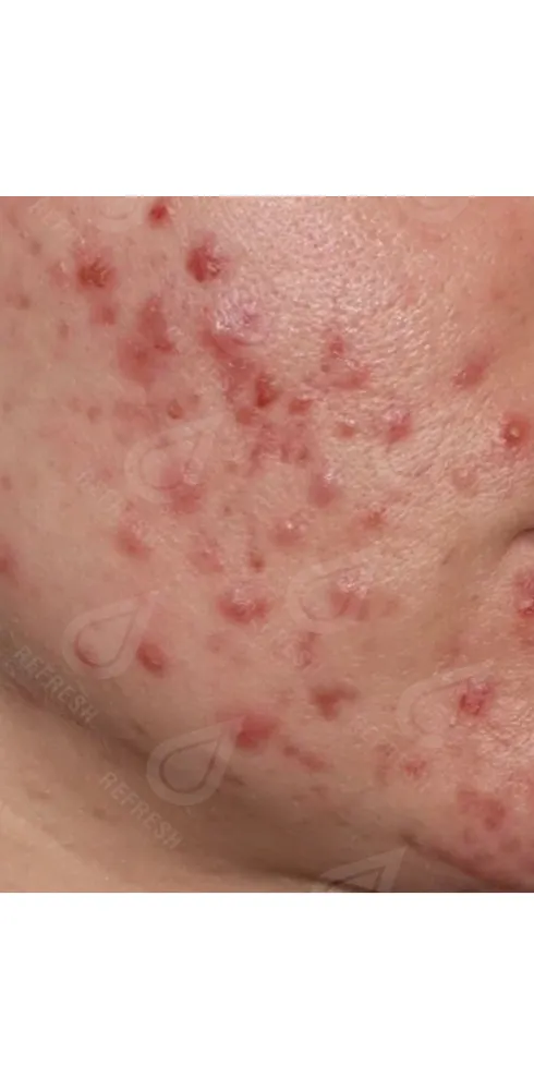 Реген.кожи3