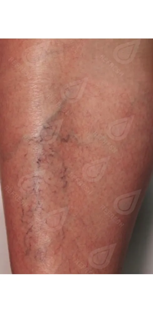 регенерация кожи 6 