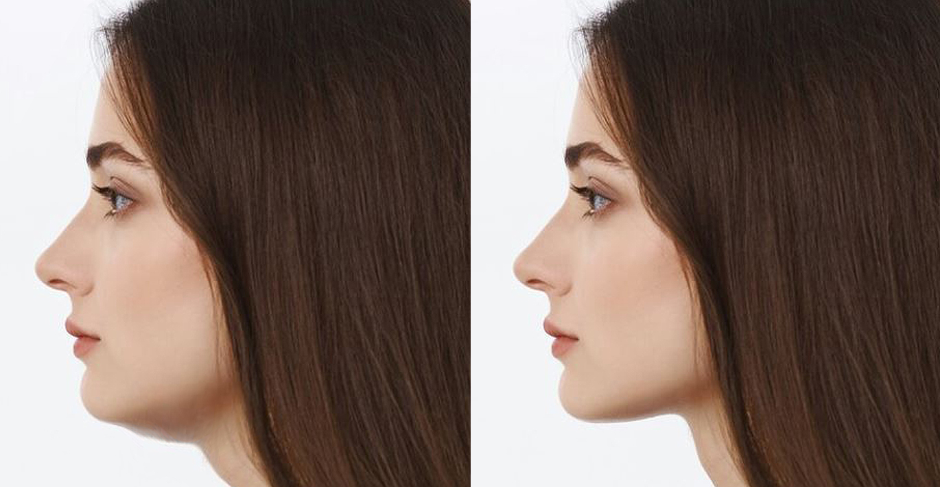 Липолиз в сочетании с RF-лифтингом — синергия, усиливающая эффект контурирования