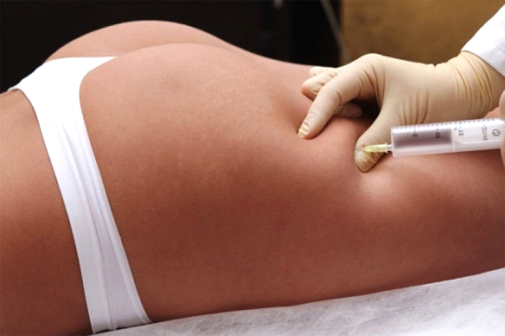 Липолитики для тела как нехирургическая альтернатива липосакции в Дубае