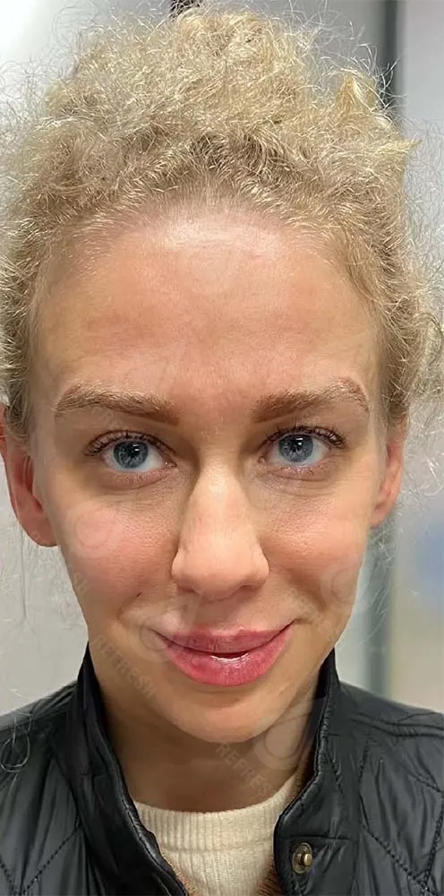  Биоревитализация 2