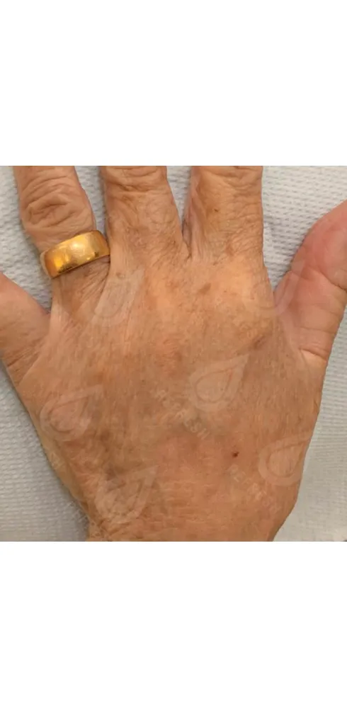 регенерация кожи 5