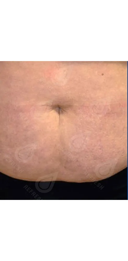 Реген.кожи7