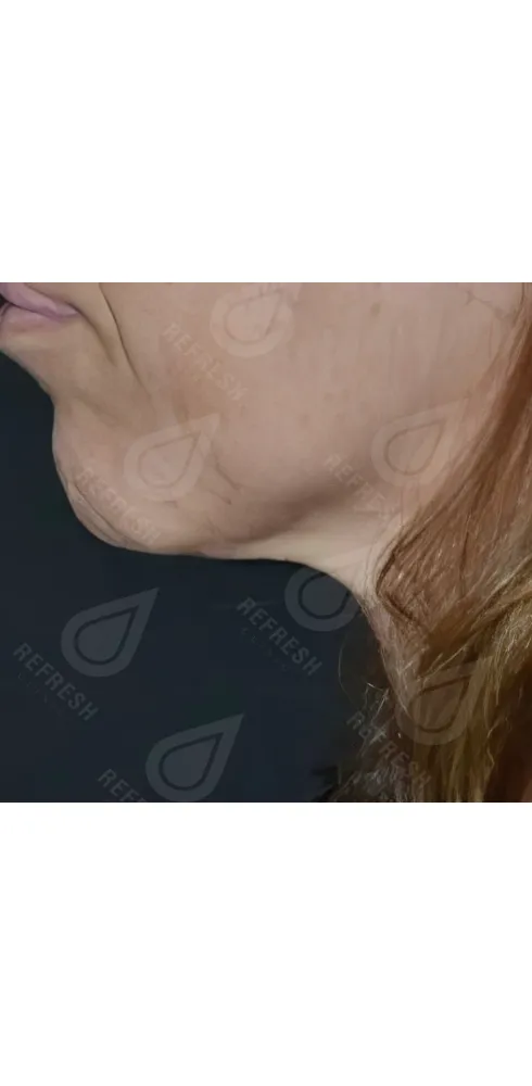 регенерация кожи 1