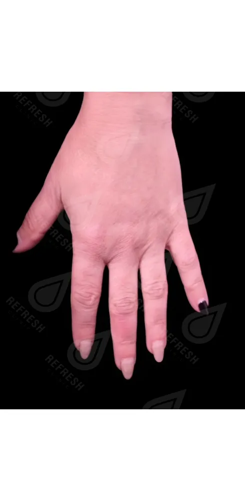 регенерация кожи 3