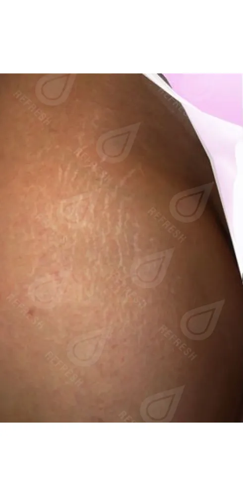 Реген.кожи8