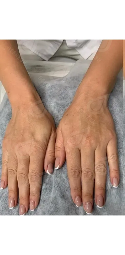 регенерация кожи 4