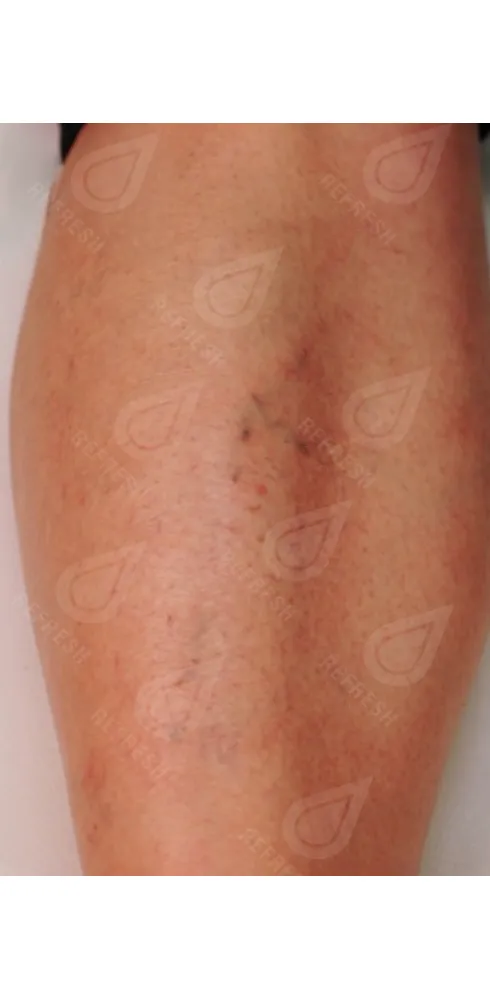 регенерация кожи 6 