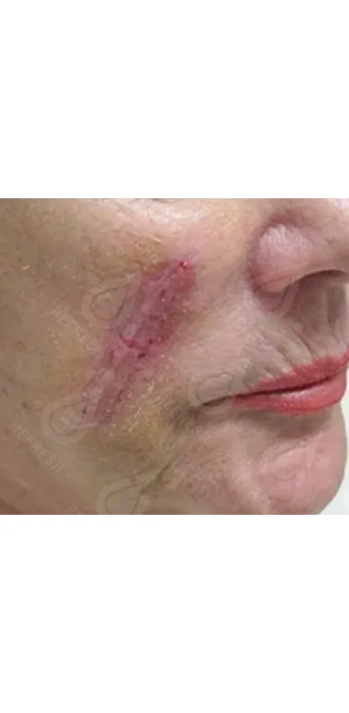 Реген.кожи4